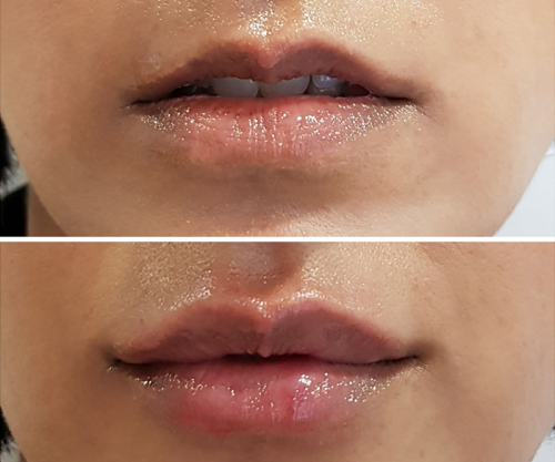 Aumento de labios e hidrataci�n